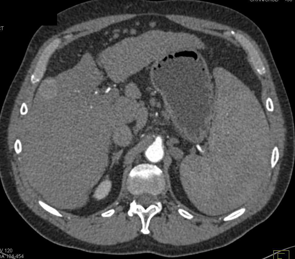 2cm Hypervascular Hepatocellular Carcinoma (Hepatoma) in a Cirrhotic Liver - CTisus CT Scan