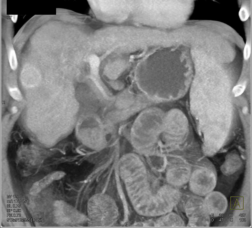 Hepatocellular Carcinoma (Hepatoma) in a Cirrhotic Liver - CTisus CT Scan