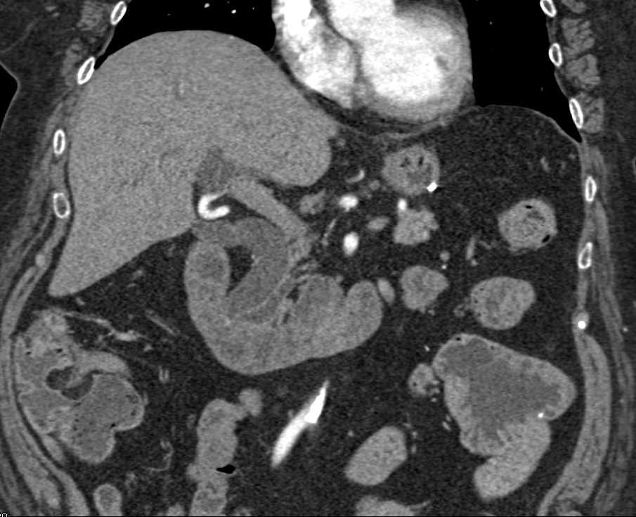 Dilated Common Bile Duct (CBD) with Tumor at Ampulla - CTisus CT Scan