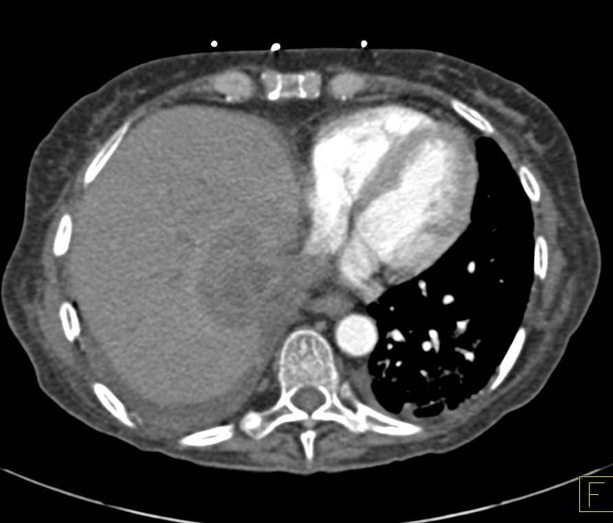 Amebic Abscess in Livers - CTisus CT Scan