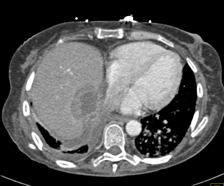Liver Abscess in the Dome of the Liver - CTisus CT Scan