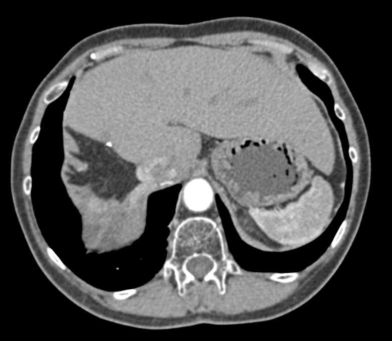 Recurrent Hepatocellular Carcinoma (Hepatoma) Invades the Inferior Vena Cava (IVC) - CTisus CT Scan