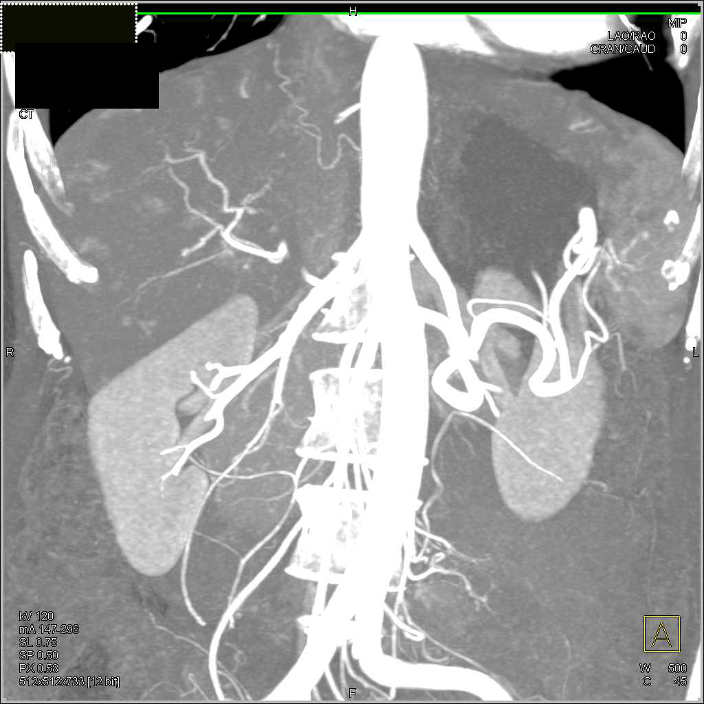 Vascular Liver Metastases Seen Best on MIP Imaging - CTisus CT Scan