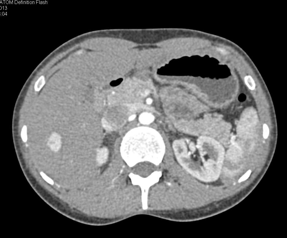 FNH Liver (Focal Nodular Hyperplasia) - CTisus CT Scan