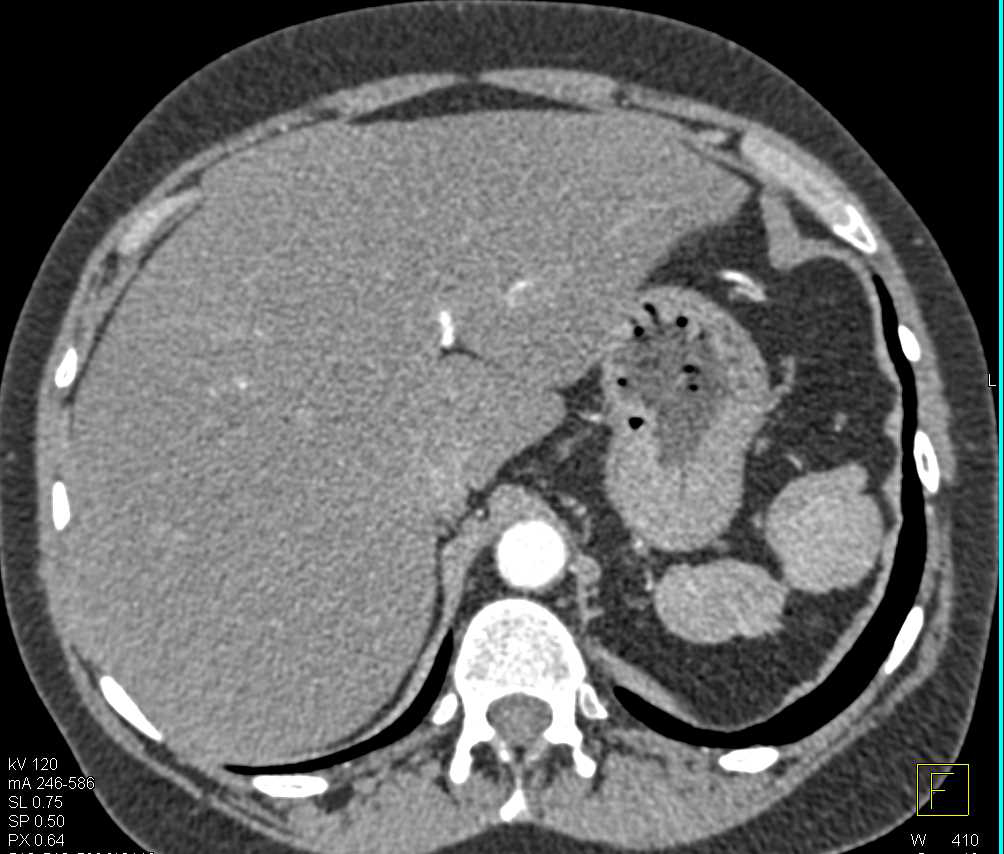 Hepatic Hemangioma and Prior Splenic Infarcts - CTisus CT Scan