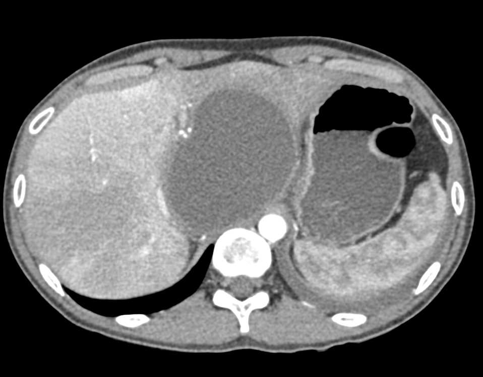 Biloma with Perfusion Changes Liver - CTisus CT Scan