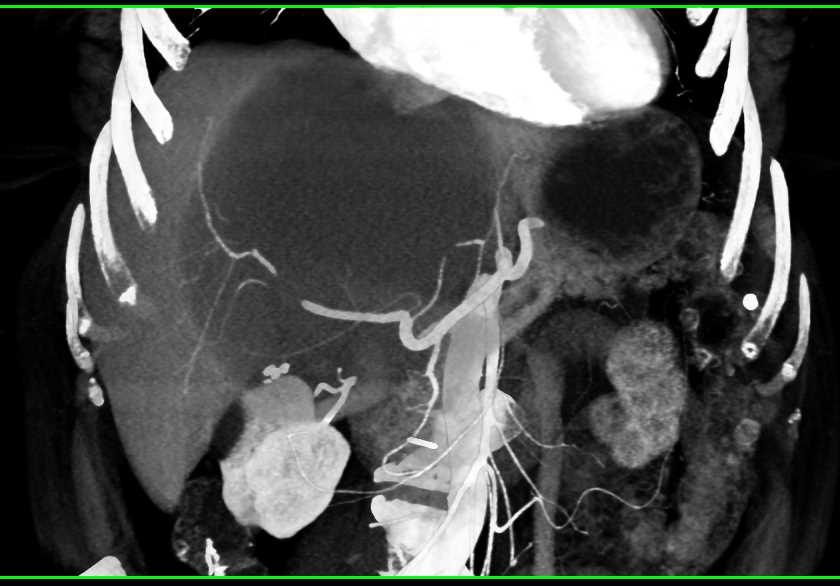 Biliary Cystadenoma - CTisus CT Scan