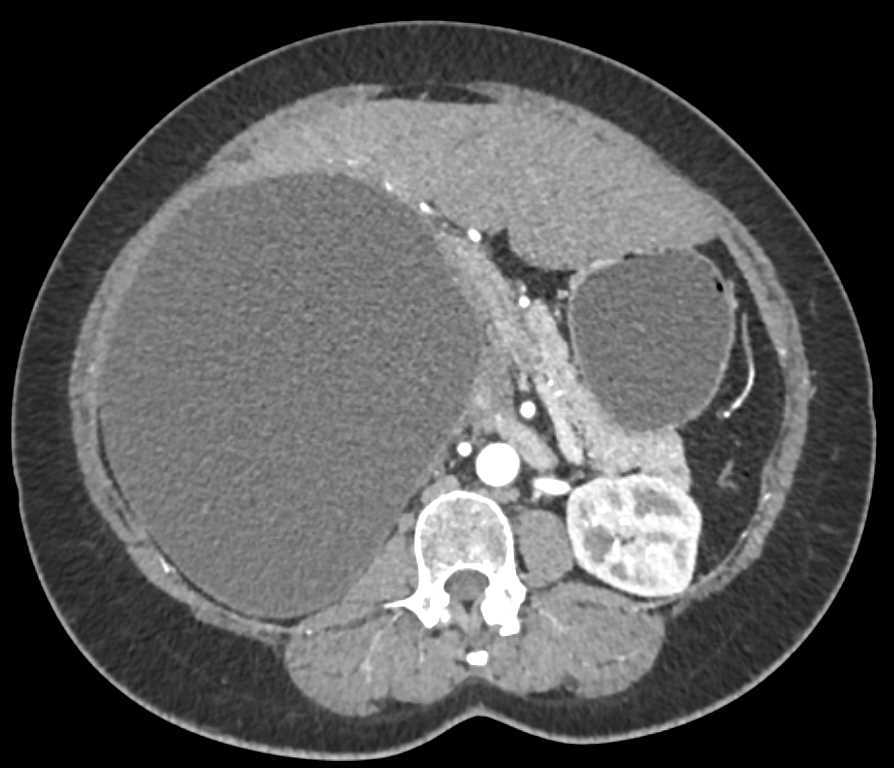 Large Hepatic Cyst - CTisus CT Scan