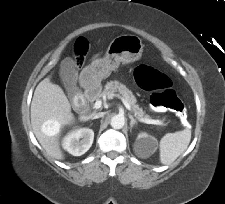 Incidental Focal Nodular Hyperplasia (FNH) Liver - CTisus CT Scan