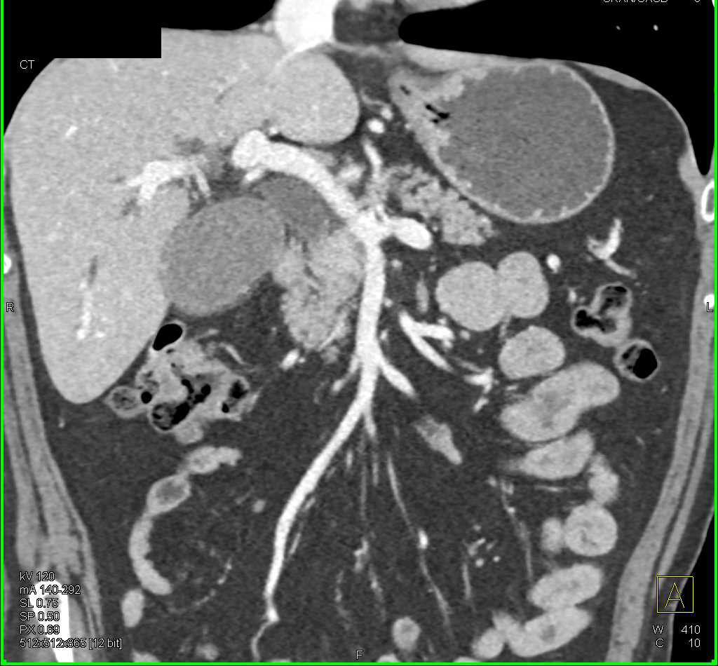 Distal Common Bile Duct (CBD) Cancer - CTisus CT Scan