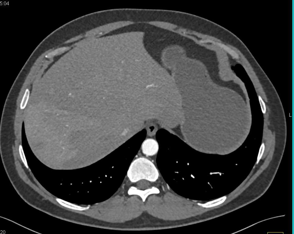 Fatty Liver with Areas of Sparing - CTisus CT Scan