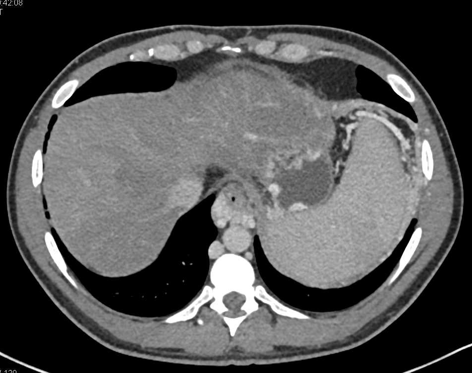 Cirrhosis with Portal Hypertension with Large Umbilical Vein and Cavernous Transformation of the Portal Vein (CTPV) - CTisus CT Scan