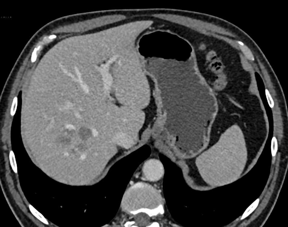 Hypodense Liver Metastases from Colon Cancer - CTisus CT Scan