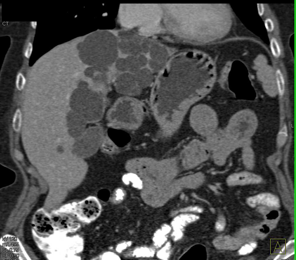 Localized Form of Polycystic Liver Disease - CTisus CT Scan