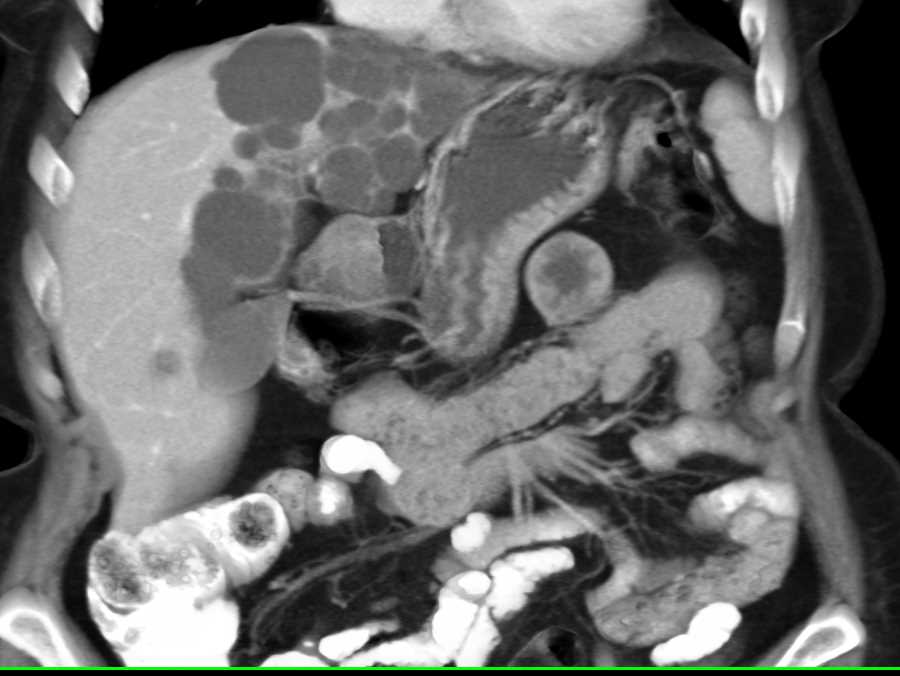 Localized Form of Polycystic Liver Disease - CTisus CT Scan