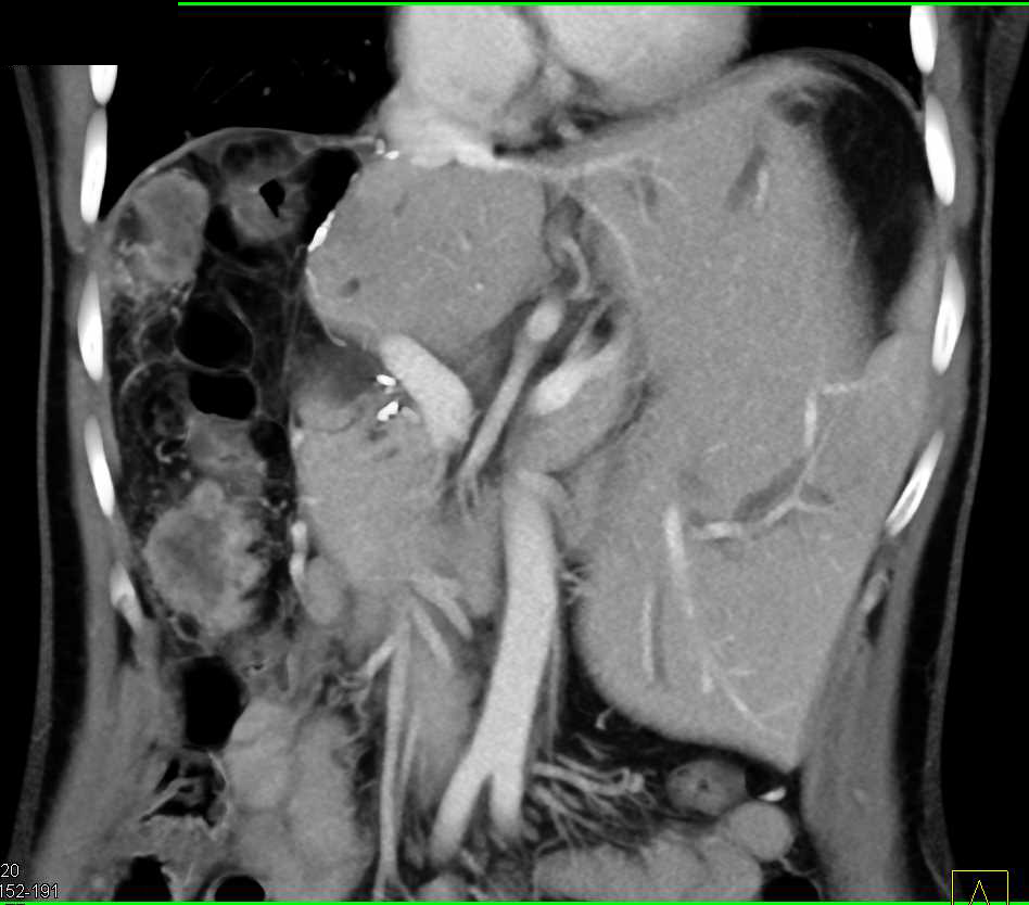 Extrahepatic Recurrence of Hepatocellular Carcinoma (Hepatoma) S/P Right Hepatectomy - CTisus CT Scan