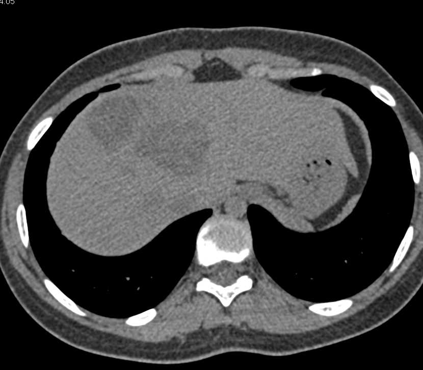 Unusual Appearance of Hydatid Liver Disease - CTisus CT Scan