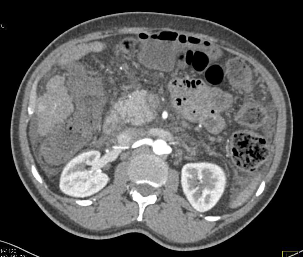 1 cm Hepatocellular Carcinoma (Hepatoma) in Right Lobe of Liver on Arterial Phase Images in Cirrhotic Liver - CTisus CT Scan