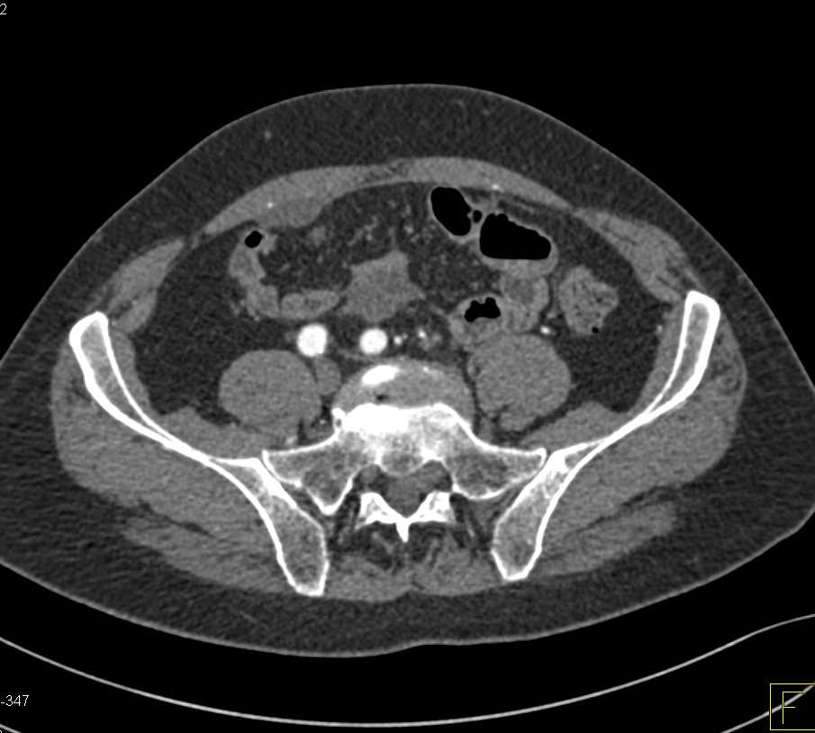 Pseudomyxoma Peritonei (PMP) with Liver Implants - CTisus CT Scan