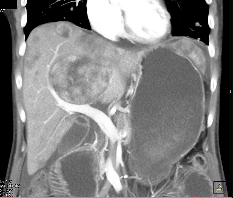 Liver and Small Bowel Metastases from Synovial Sarcoma - CTisus CT Scan