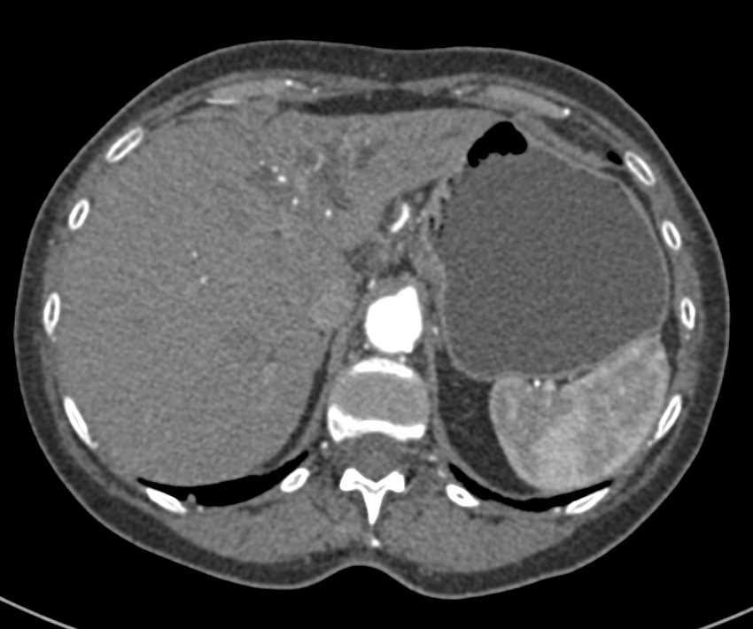 Cholangiocarcinoma with Left Ductal Dilatation and Atrophy of Left Lobe - CTisus CT Scan