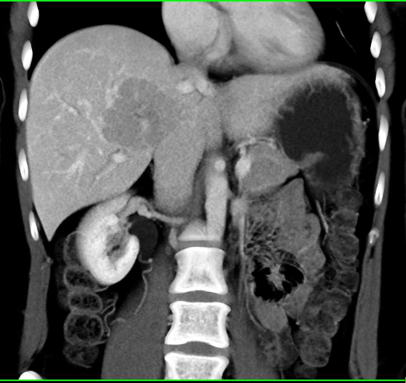 Focal Nodular Hyperplasia Liver (FNH) - CTisus CT Scan