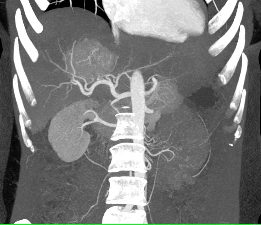 Focal Nodular Hyperplasia Liver (FNH) - CTisus CT Scan