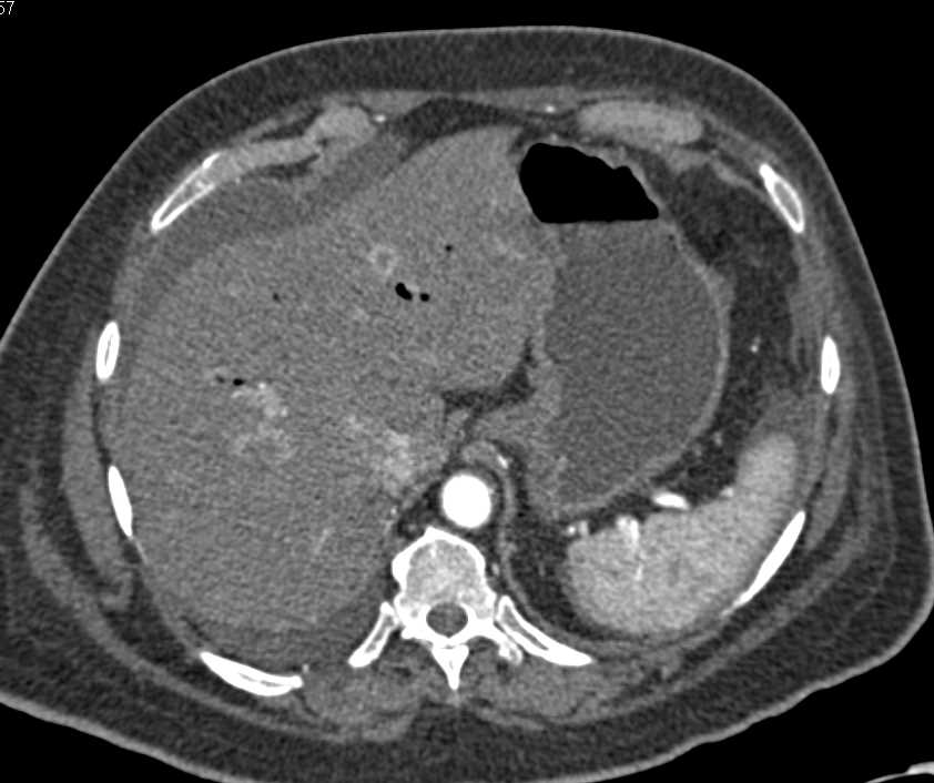 Thickened Small Bowel with Liver Metastases - CTisus CT Scan