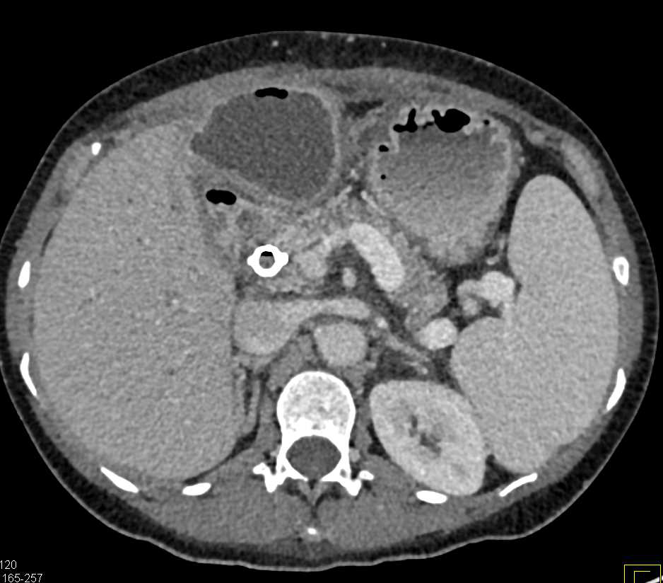 Hepatic Abscesses - CTisus CT Scan