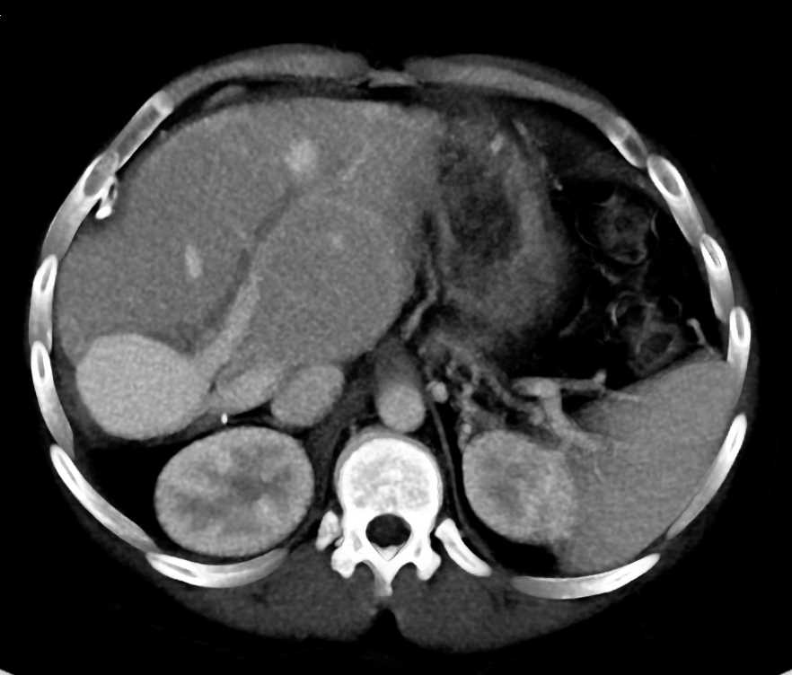 Pulmonary Vein Aneurysm Simulates a Pancreatic Mass - CTisus CT Scan