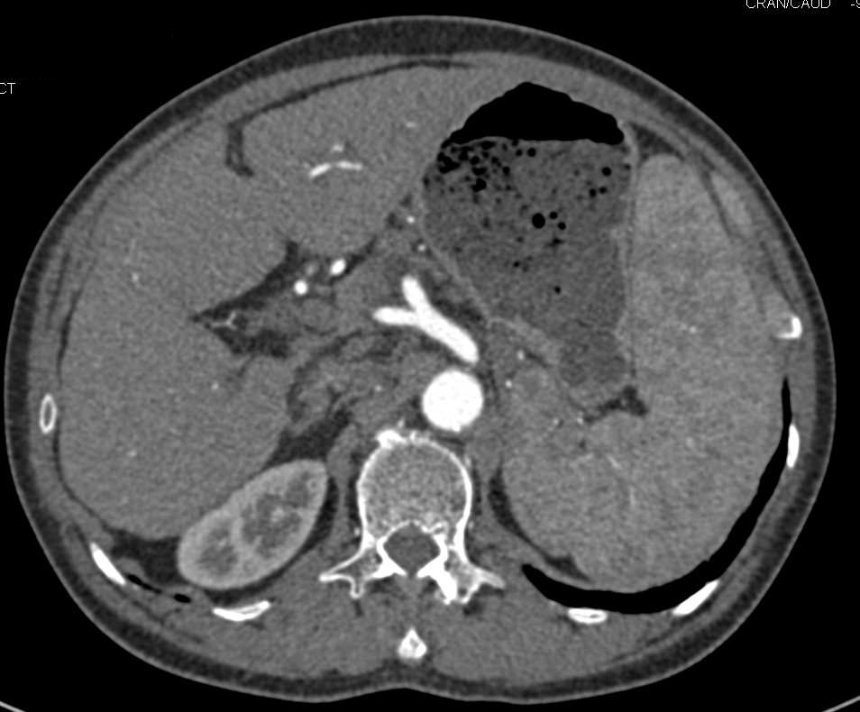 Cirrhosis with Portal Hypertension - CTisus CT Scan