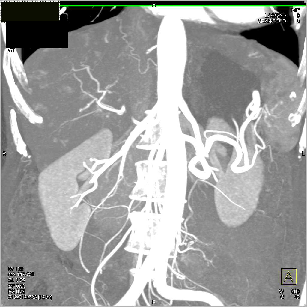 Neovascularity with Vascular Lesions in the Liver - CTisus CT Scan