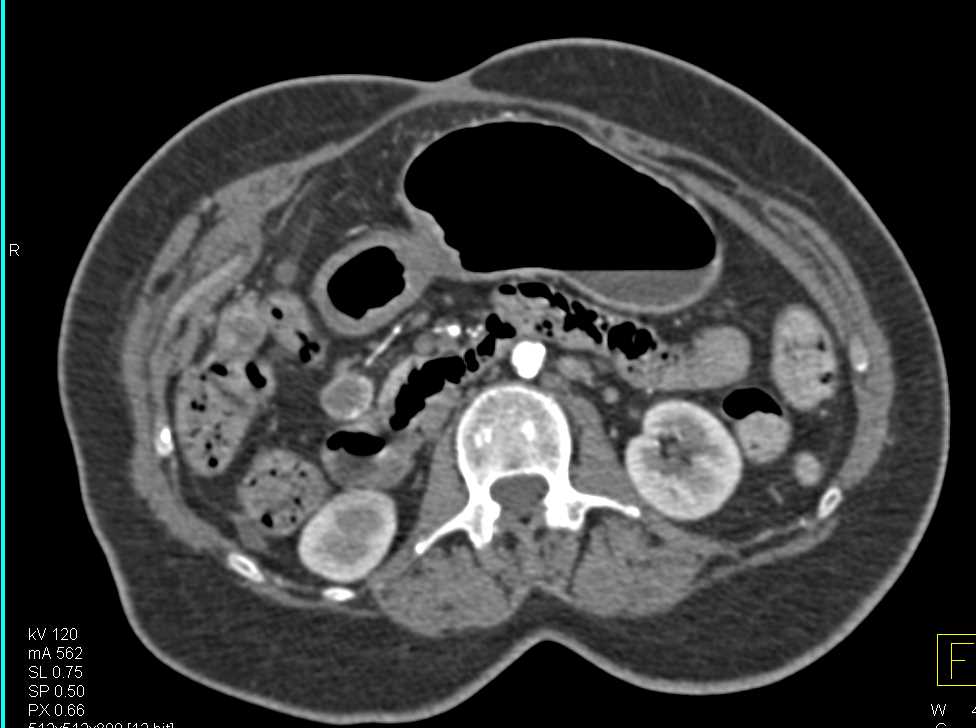 Recurrent Hepatocellular Carcinoma (Hepatoma) with Enhancing Node in Mesentery - CTisus CT Scan