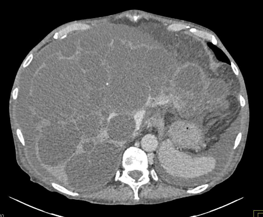 Polycystic Liver Disease - CTisus CT Scan