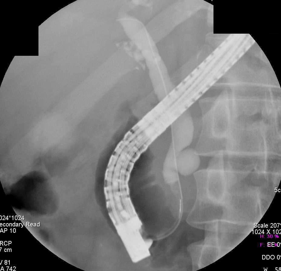 Choledochal Cyst off Common Bile Duct - CTisus CT Scan