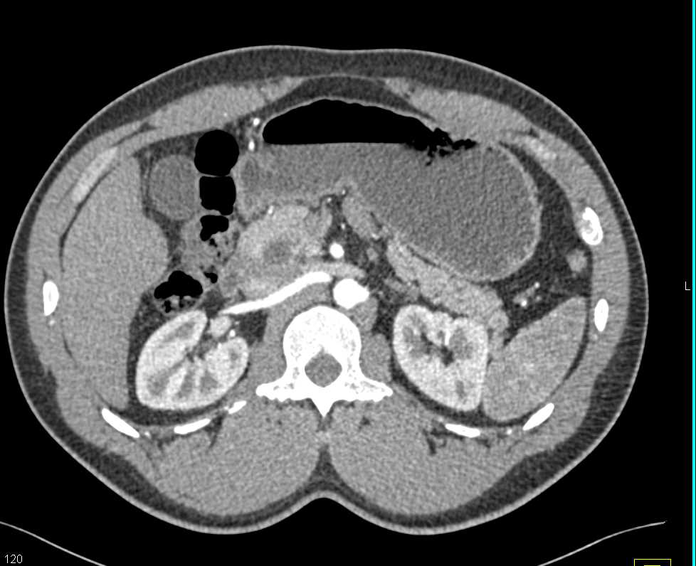 Choledochal Cyst off Common Bile Duct - CTisus CT Scan