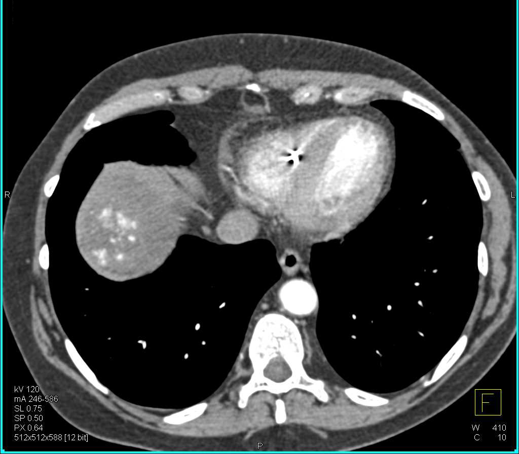 Dual Phase Imaging with 3D Maps of Hepatic Hemangioma - CTisus CT Scan