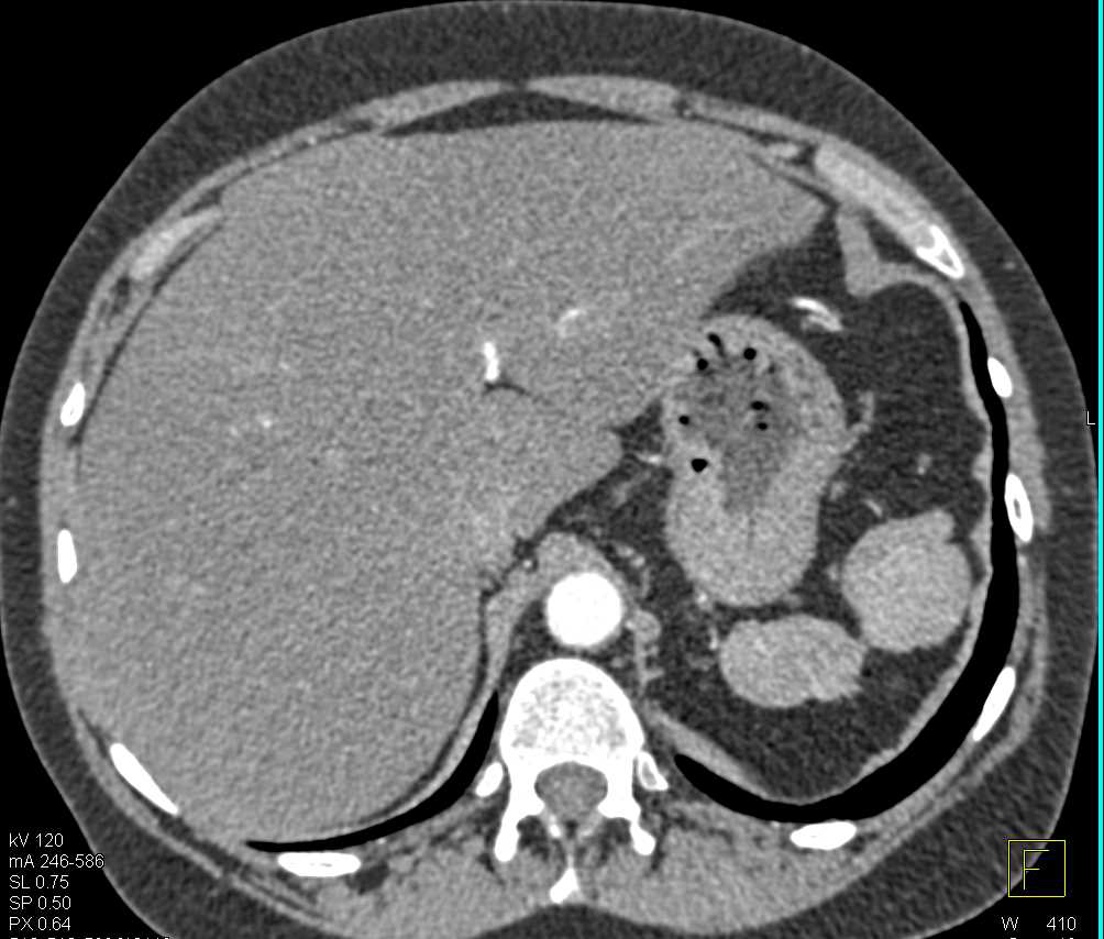 Hemangioma in the Dome of the Liver - CTisus CT Scan