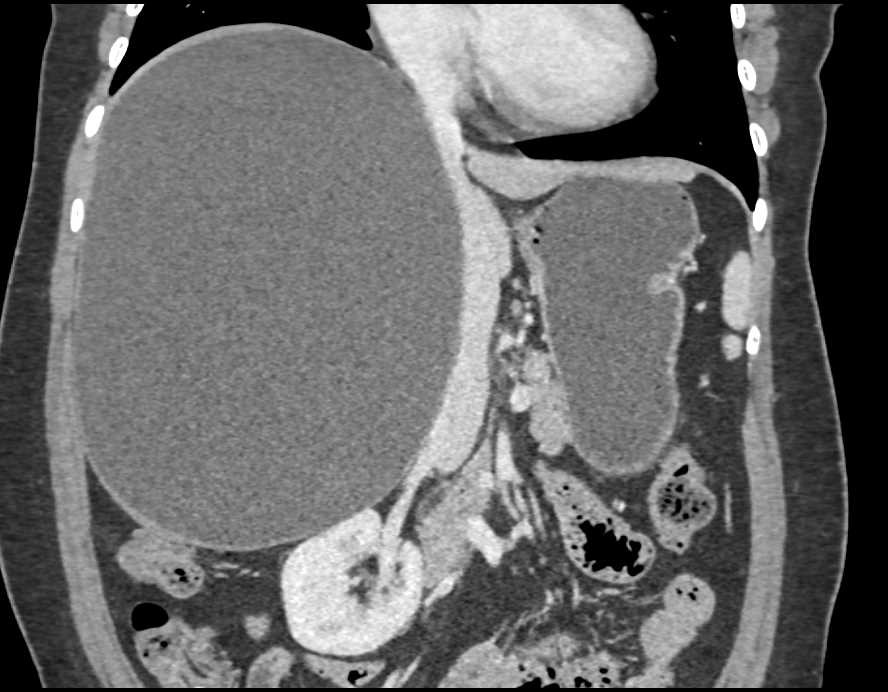 Large Simple Hepatic Cyst - Liver Case Studies - CTisus CT Scanning