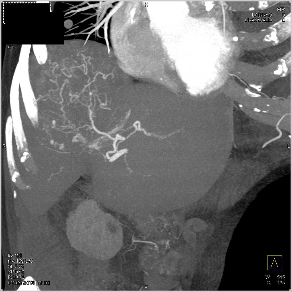 Hepatocellular Carcinoma (Hepatoma) with Neovascularity and Central Scar - CTisus CT Scan