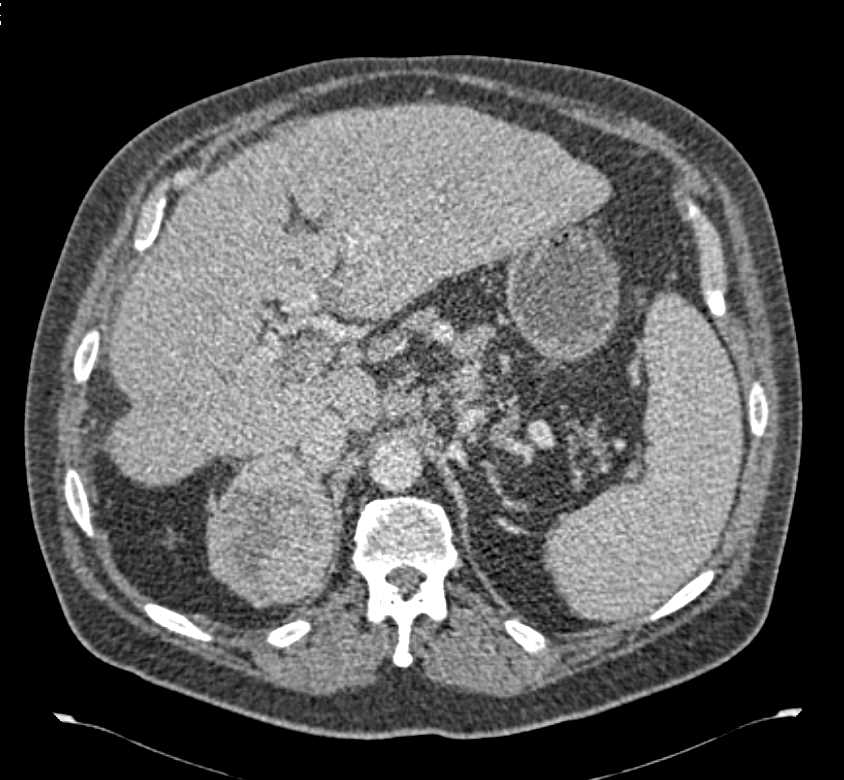 Hepatocellular Carcinoma (Hepatoma) with Adrenal and Bone Metastases - CTisus CT Scan