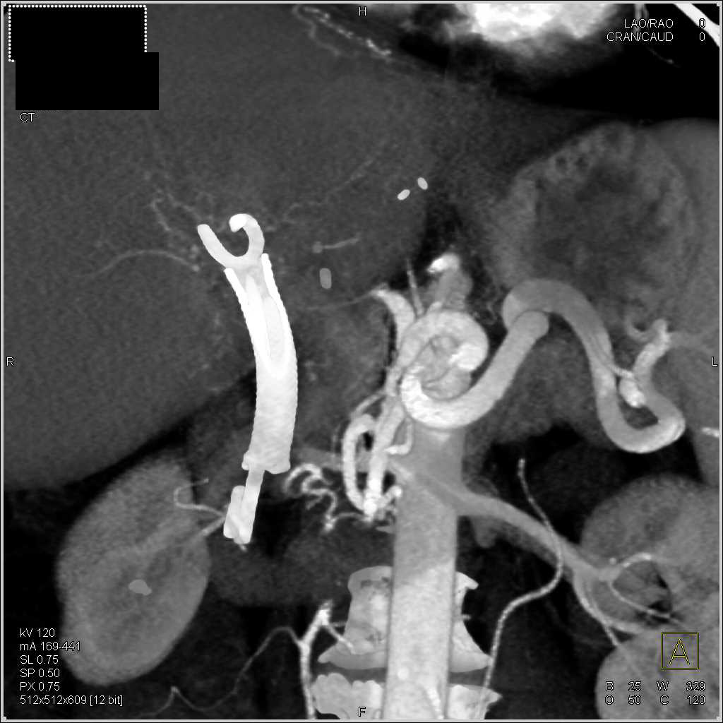 Central Cholangiocarcinoma - CTisus CT Scan