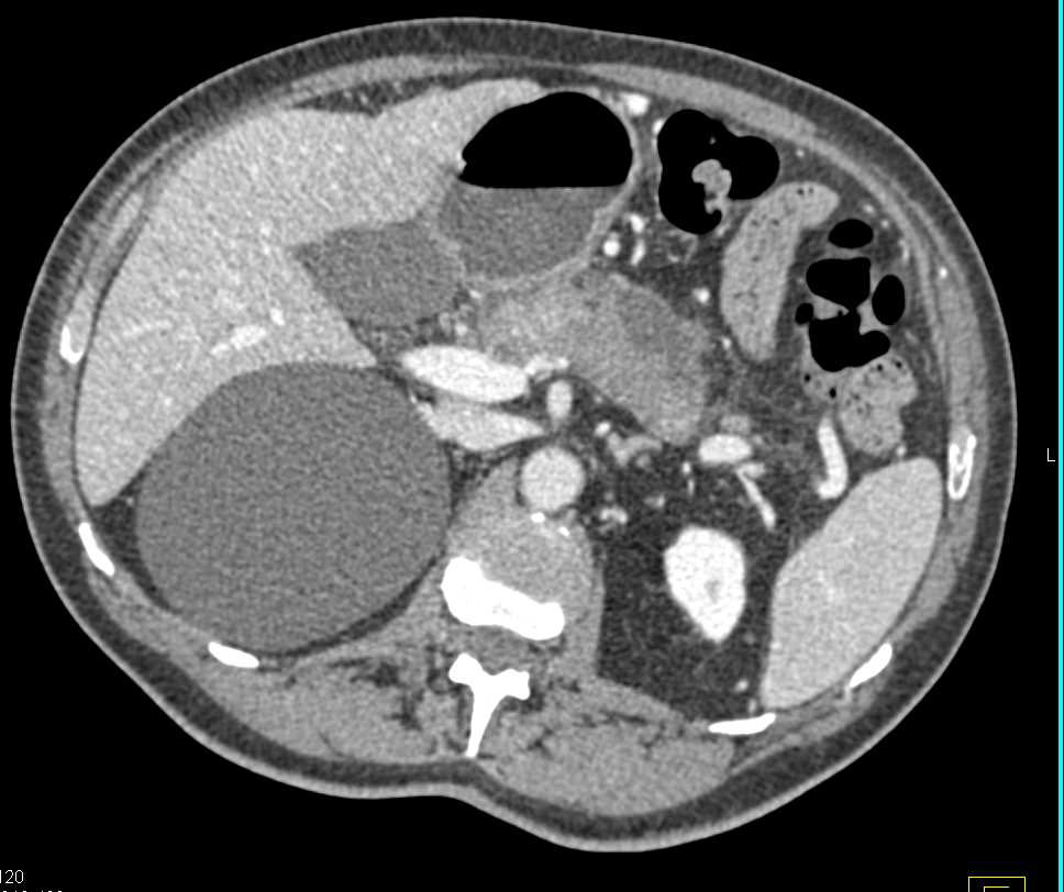 Hemangioma in a Patient with Pancreatic Cancer - CTisus CT Scan