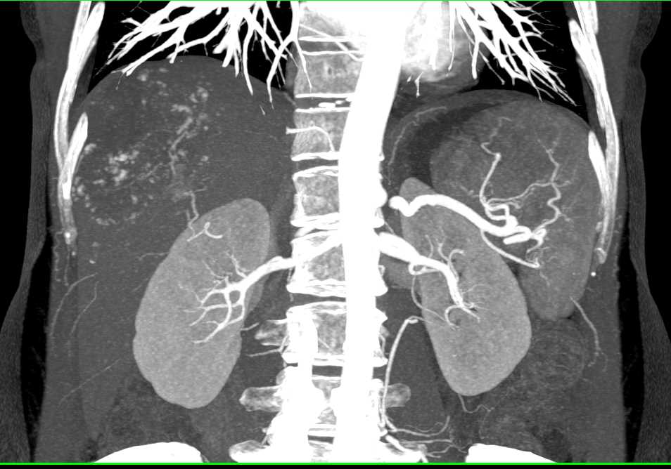 CTA of Hemangioma of the Liver - CTisus CT Scan