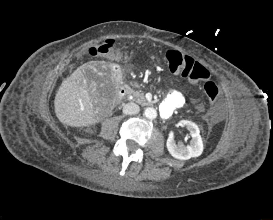 Hepatic Infarction - CTisus CT Scan