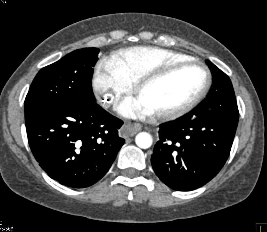 Cirrhosis with Portal Hypertension and Occluded Transjugular Intrahepatic Portosystemic Shunt (TIPS) Catheter - CTisus CT Scan