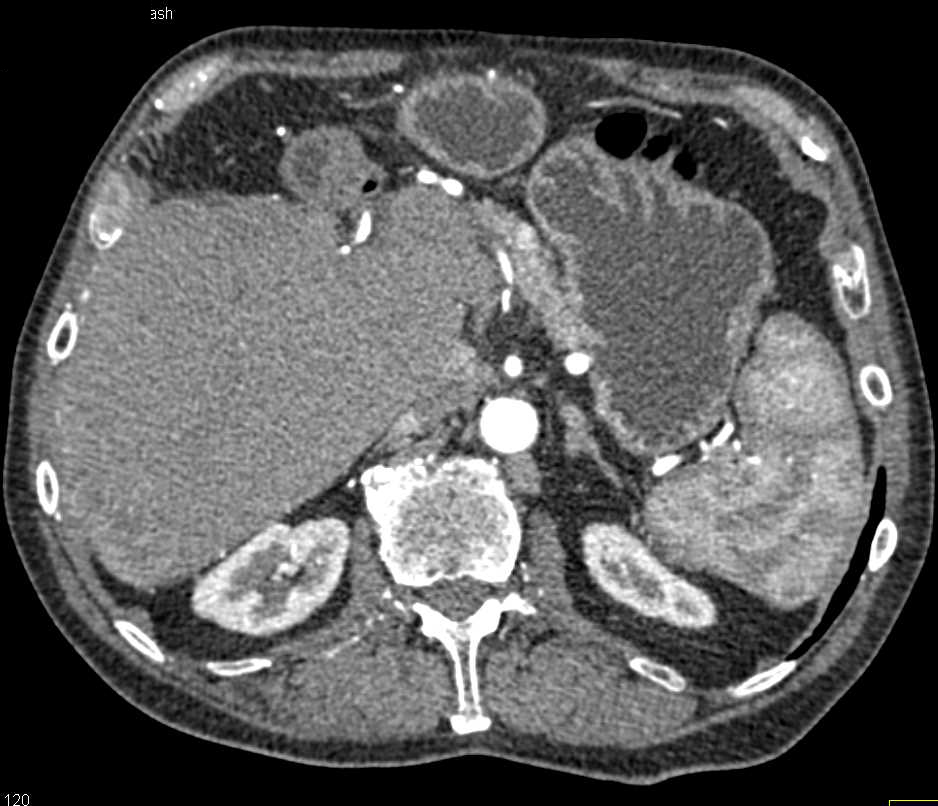 Hepatocellular Carcinoma (Hepatoma) in a Cirrhotic Liver - CTisus CT Scan