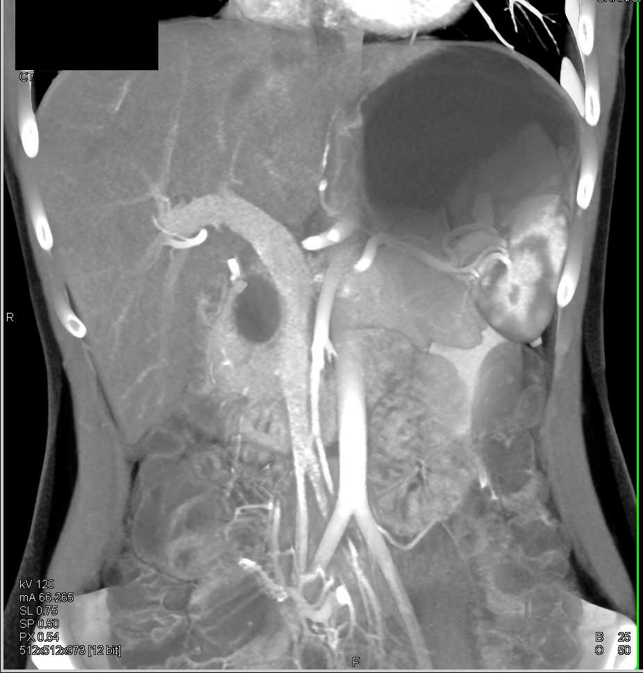 Choledochal Cyst - CTisus CT Scan