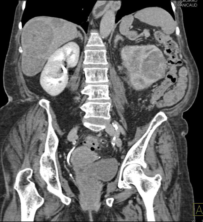 Renal Lymphoma with Liver Metastases - CTisus CT Scan