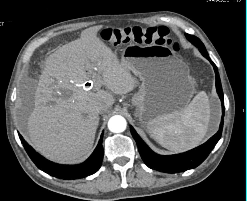 Cholangiocarcinoma - CTisus CT Scan